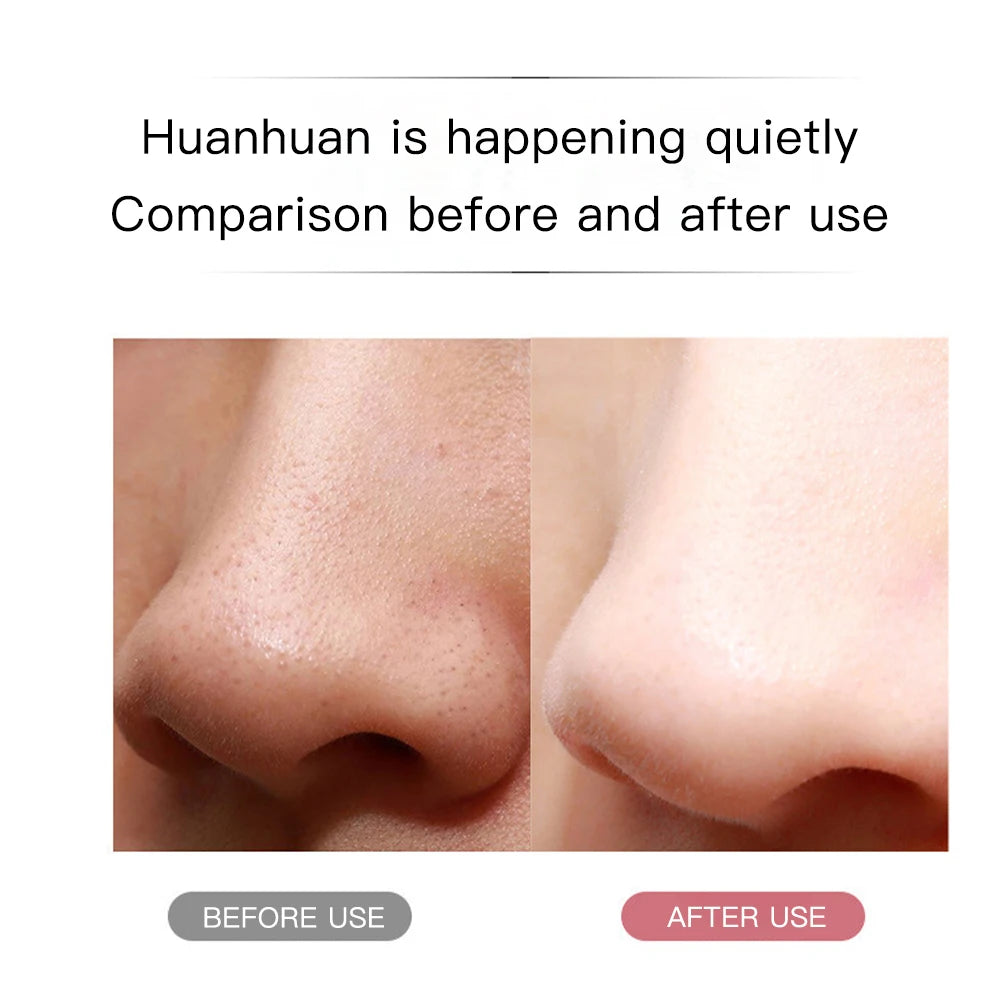 Remover kit detail